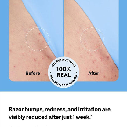 Iridelle SmoothStick Ingrown Hair Relief